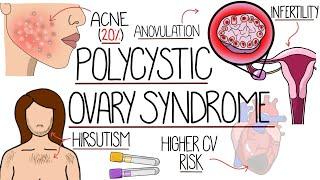 Polycystic Ovary Syndrome Made Easy (PCOS Explained)