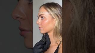 Ultraformer MPT HIFU | Non-Surgical Jawline Lift and Skin Tightening #skincare #ultraformermpt