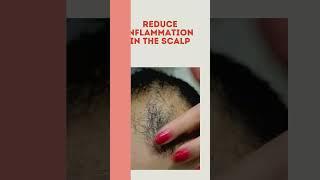 Top 5 benefits of hair PRP therapy | PRP for Hair Loss | Skinaa Clinic viral #shorts