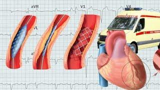 Стентирование сосудов сердца, лечение инфаркта миокарда
