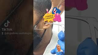 Ear cleaning (removal of Q-tip or swab)