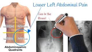 Pain in lower left abdomen - Low Stomach Pain, Most Common Causes