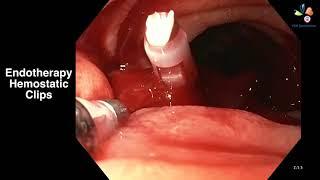 Mr. Kumar Patient Endotherapy Hemostatic Clips Video