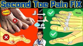 Second Toe Pain TREATMENT [Capsulitis, Taping & Freiberg Disease FIX]