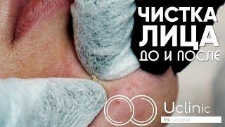 Чистка лица | Показываем процедуру | До и после