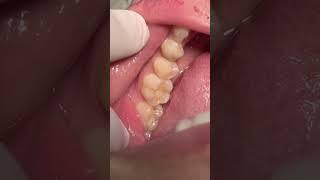 Replace old composite restoration #dentist
