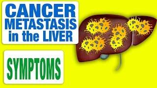 Cancer Metastasis in the Liver - All Symptoms