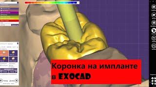 Цирконий на Импланте в exocad. Моделировка коронки на имплантатах в цифре. Моделирование зубов.