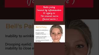 Bell's Palsy Causes , Symptoms and treatment at home.Bells palsy exercise, Bell's palsy anatomy