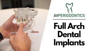 Full Arch Dental Implants - Manhattan, NY - Dr. Alexander Volchonok