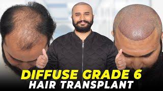 Hair Transplant in Amritsar | Best Results & Cost of Hair Transplant in Amritsar