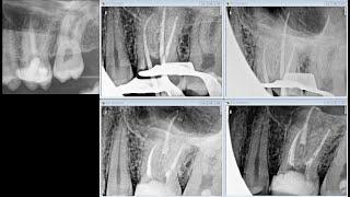 Upper molar retreatment