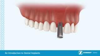 Introduction to Dental Implants