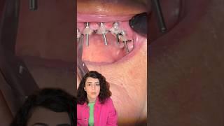 Full mounts transformation Evident #digitaldentist #dentist #dentistry #dentaltechnology #dental