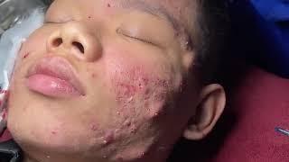 Blackheads & Milia, Big Cystic Acne Blackheads Extraction whiteheads Removal pimple Popping ##001