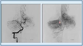 2020 02 08 BANANA Bites -- STROKE -- hypodense basilar sign aspiration angioplasty sca thrombectomy