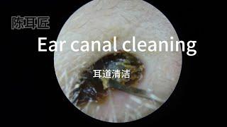 Ear canal cleaning  Double pleasure