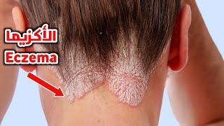 ماهي الاكزيما وما هو احدث علاج ليها_ ?What is eczema