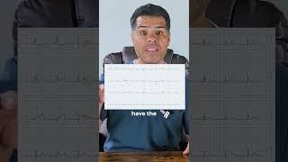 Recognizing STEMI: Case Review of a 54-Year-Old with RCA Occlusion