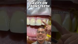 Is that a Front Tooth GAP or a CAVITY?! Dentist Explains | View Mobile Dental #shorts