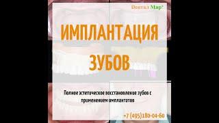 Имплантация зубов. Восстановление всех зубов с применением имплантатов