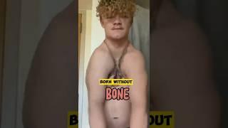 Born without Bones #shorts #bones
