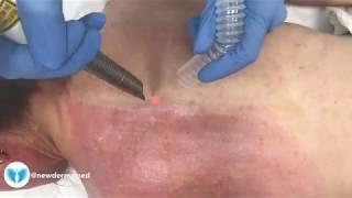 Laser Skin Resurfacing Body treatment!