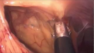 Removing An Eroded Gastric Band | Weight Loss Surgery | Dr. Alvarez