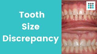TOOTH SIZE BOLTON DISCREPANCY #Shorts l Dr. Melissa Bailey