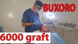 Soch ekish 6000 graft Buxoro shaxri 18 oydan keyingi natija