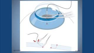 Corneal Suturing, Part 1- A Curriculum for Suturing the Cornea