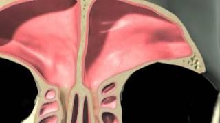 Balloon Sinuplasty and FESS Animation with Voiceover