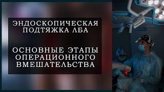 Эндоскопическая подтяжка лица, подтяжка кожи лба. Подтяжка лица. SMAS Подтяжка лица.