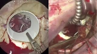 Step by stepTransaxillary direct view MVR