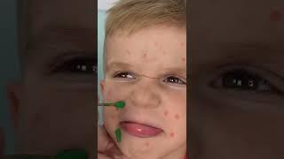 My brother has a Chickenpox#shortsvideo #shorts