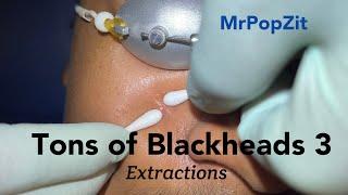 Tons of Blackheads part 3. Acne extractions. Many comedones removed. Patient improving. MrPopZit