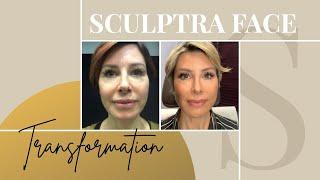 Sculptra Before & After | My Review on the Non-Surgical Facelift | Dominique Sachse