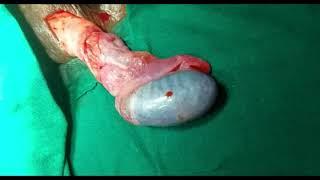 EMERGENCY SCROTAL EXPLORATION, DETORSION & ORCHIOPEXY FOR RIGHT TESTICULAR TORSION IN 13 YEAR BOY