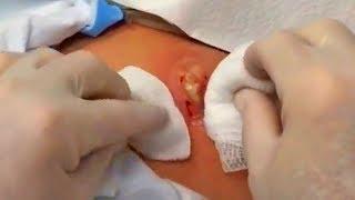 10-Year-Old Cyst Revisited from Dr. Gilmore Fan Page