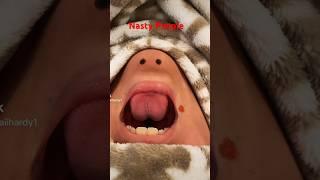 ROSY HAS ANOTHER PIMPLE #viral #funny