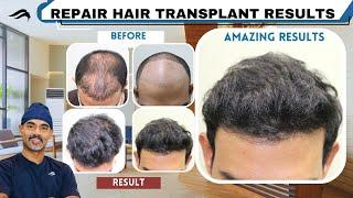 Hair Transplant In Chennai | Best Center Surgeon Cost & Results Of Hair Transplant Of Chennai