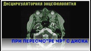 Заключение МРТ головного мозга показало дисциркуляторную энцефалопатию