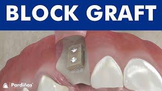 Dental bone graft for implants - Block Bone grafting ©