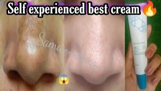 Self experienced best cream for melasma | melaneez cream review