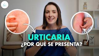  URTICARIA | Que es? Sintomas y tratamiento! @drapilarochoa - Dermatologa