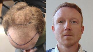 Hair Transplant Before and After - Month by Month Results | Elithair #2