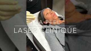 TCA Chemical Peel by P. Alexander Ataii, M.D. at Laser Clinique