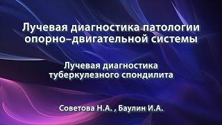 Советова Н.А. – Лучевая диагностика туберкулезного спондилита