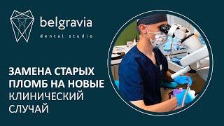  Замена старых пломб на новые. Клинический случай Belgravia Dental Studio