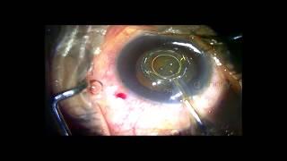 Zepto Cataract Surgery First Time